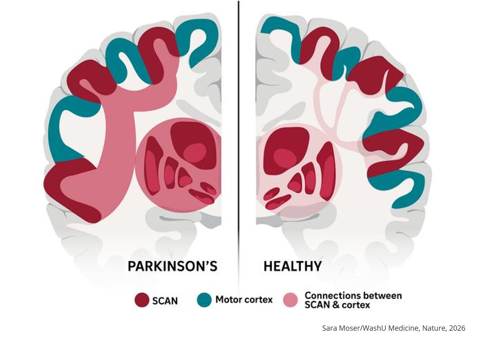 Parkinson’s disease as a somato-cognitive action network disorder