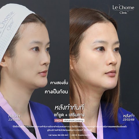 แก้ขูดฟิลเลอร์+เสริมคาง