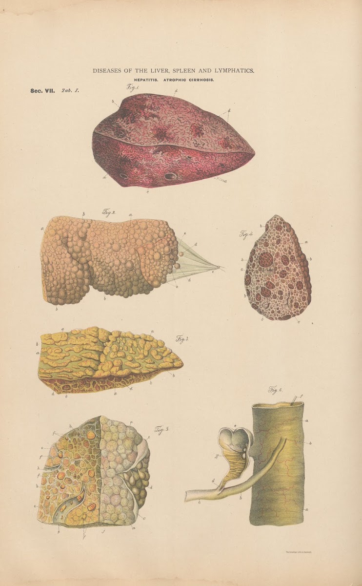 HyperæMia And Inflammation Of The Liver 1888