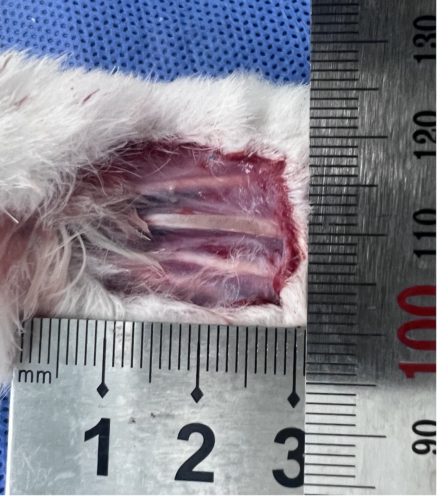 Transverse tibial bone transfer accelerates healing of foot ulcers in a rabbit model of type 2 diabetes mellitus: involvement and regulation of circular RNA