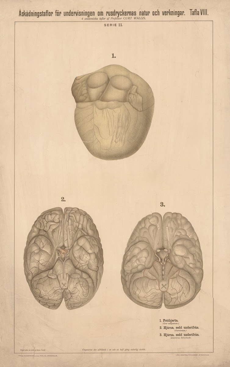 Fatty heart healthy brain and calcified brain 1904