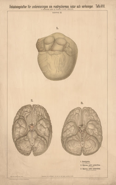 Fatty heart healthy brain and calcified brain 1904