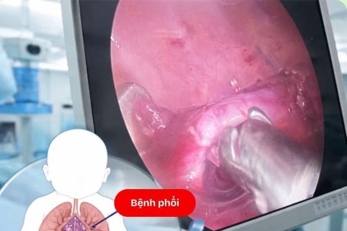 Phẫu thuật điều trị dị dạng phổi bẩm sinh hiếm gặp ở trẻ em - Báo Tri thức &amp; Cuộc sống