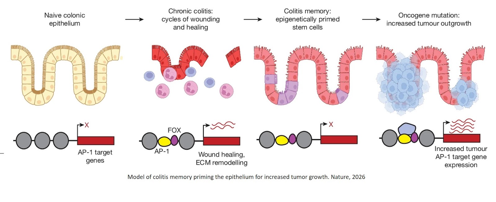 Epigenetic memory of colitis promotes tumour growth