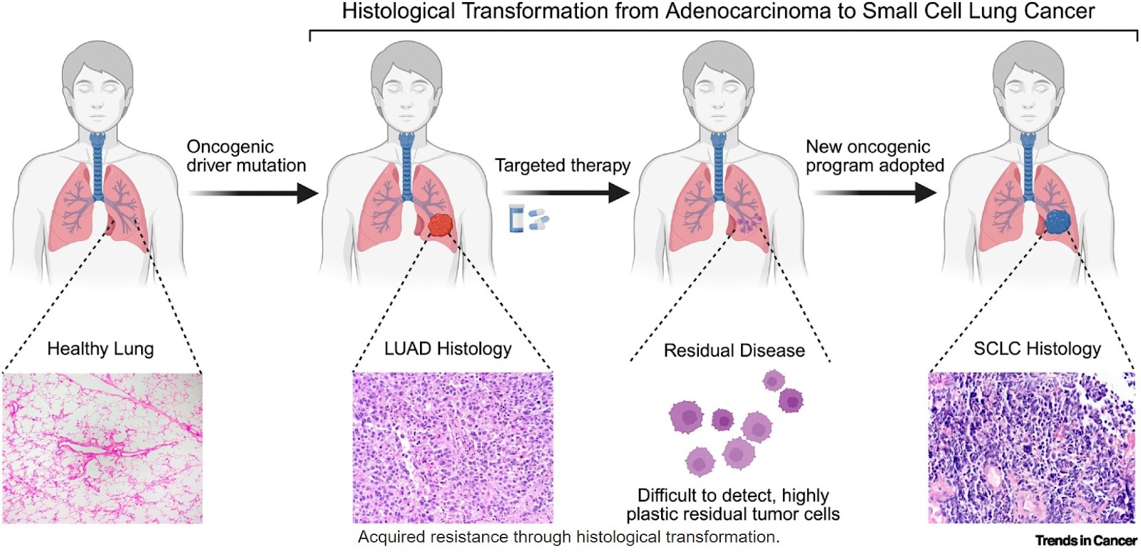 Dissecting histological transformation
