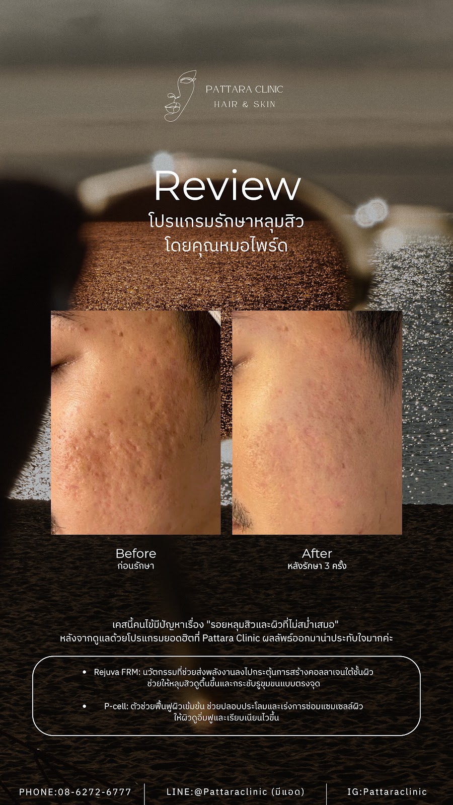 รีวิวหลุมสิว Microneedle RF เคสที่ 2