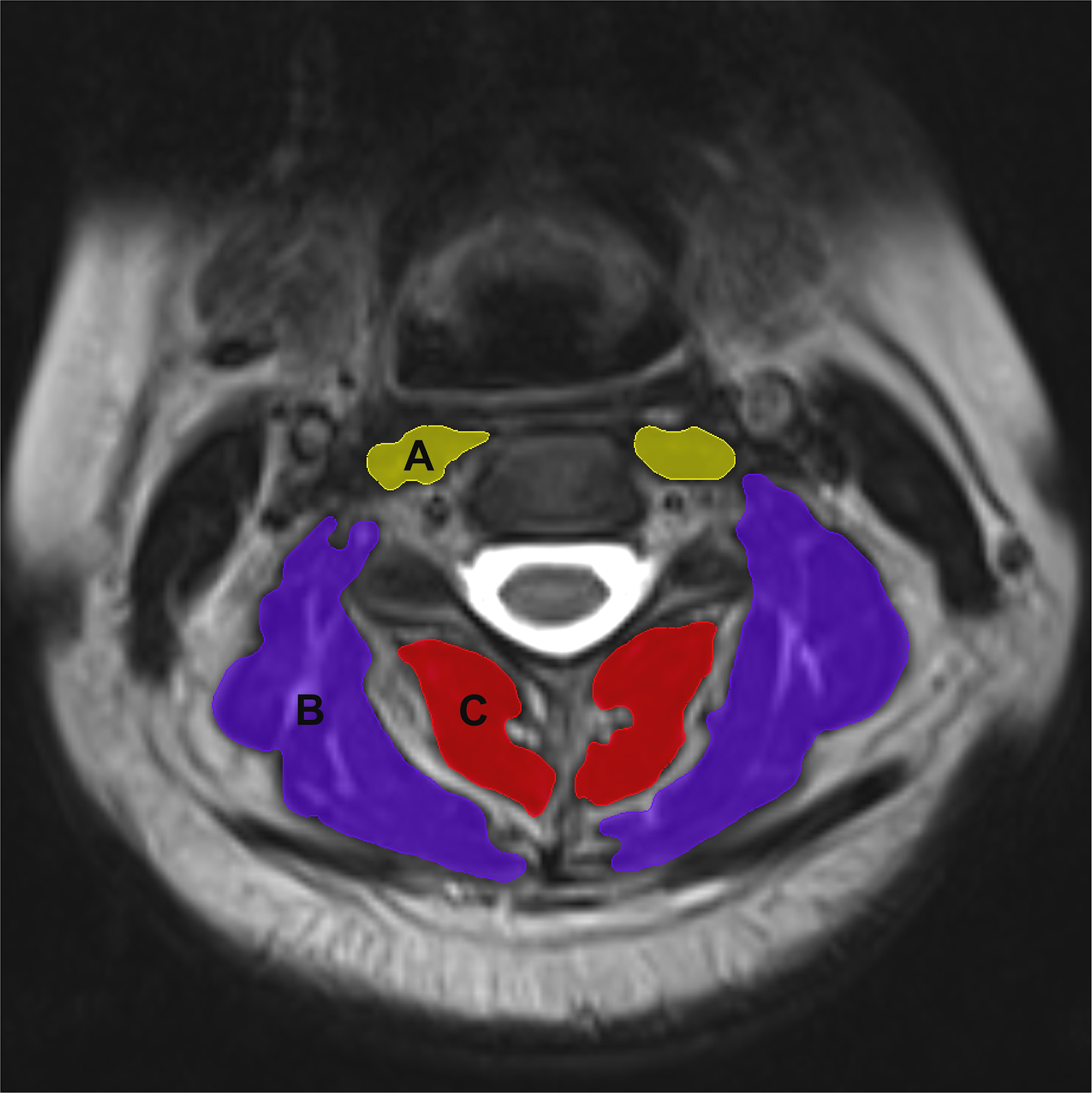 Correlation between cervical instability and neck muscle changes in middle-aged and young adults