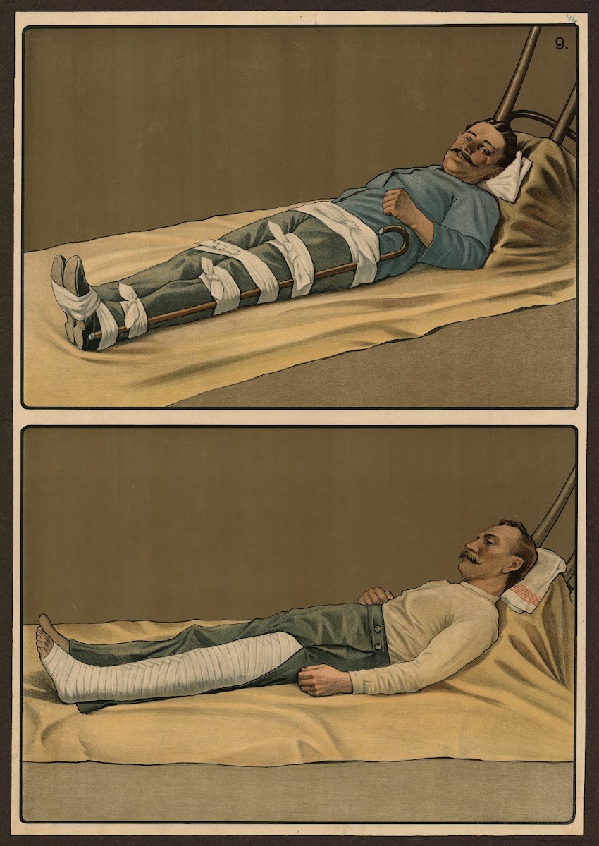 Emergency treatment for broken bones 1911