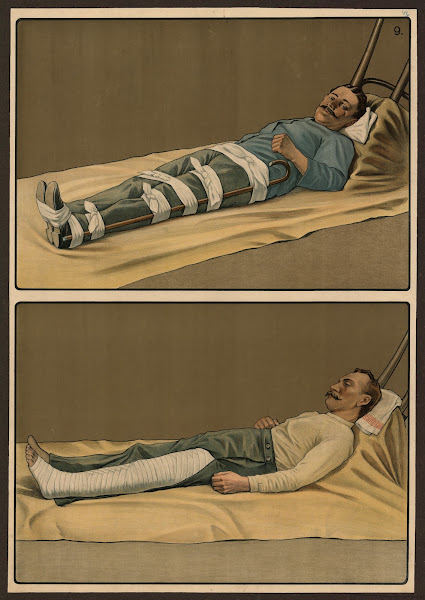 Emergency treatment for broken bones 1911