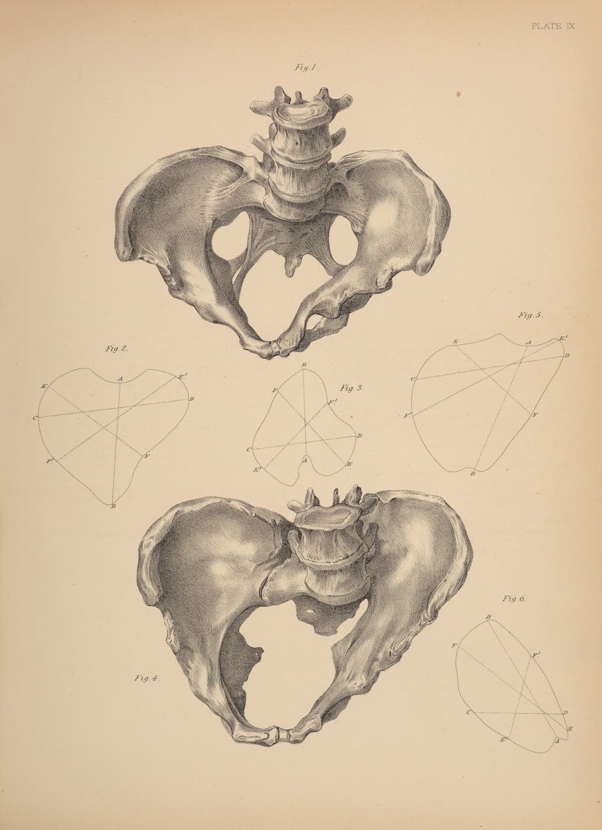 Malformation of the Pelvis 1885