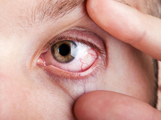 Dry eye evaluation at the slit lamp at Dayal Eye Centre