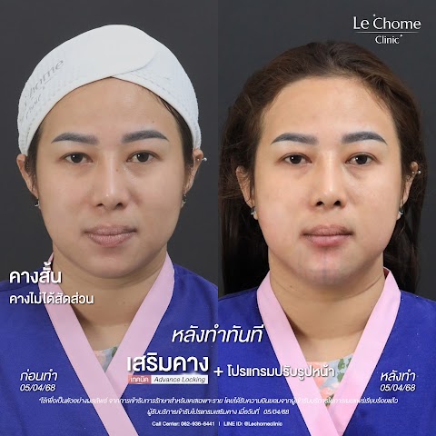 เสริมคาง (ใหม่)
