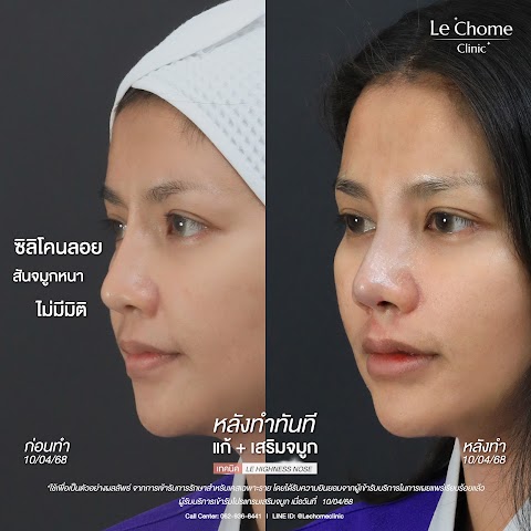 แก้+เสริมจมูก