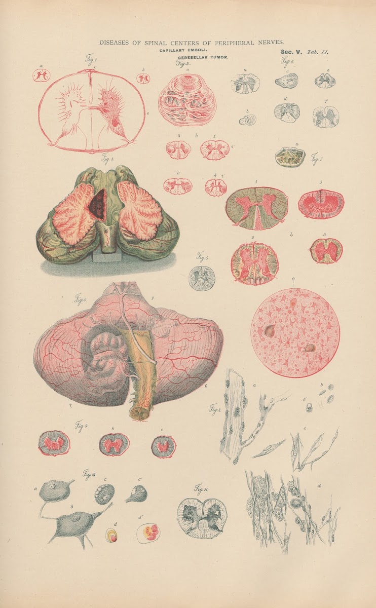 Capillary Emboli In Spinal Marrow 1888