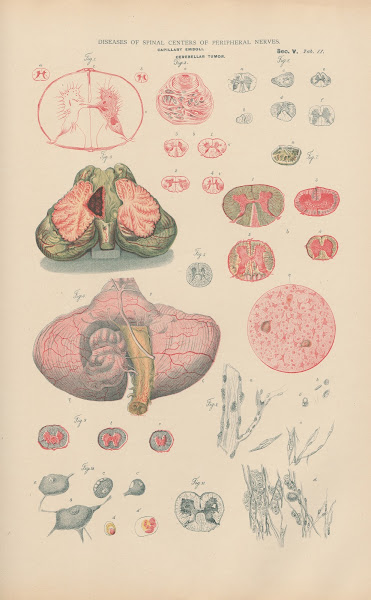 Capillary Emboli In Spinal Marrow 1888
