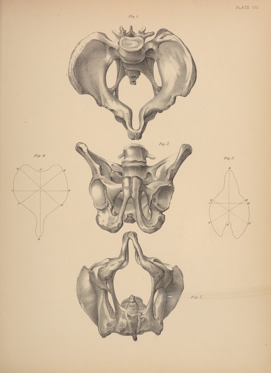 Malformation of the Pelvis 1885