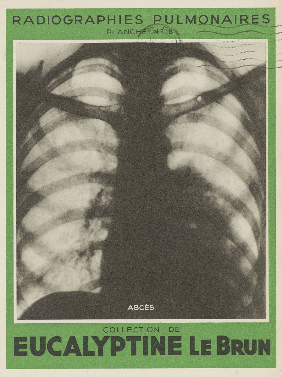 Abcès 1910 1950