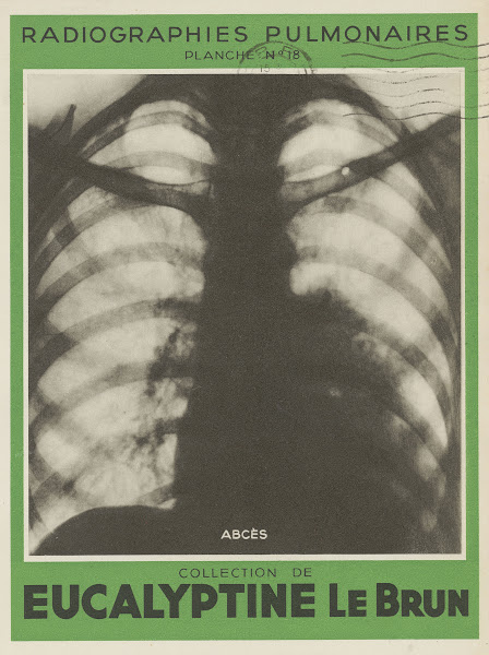 Abcès 1910 1950