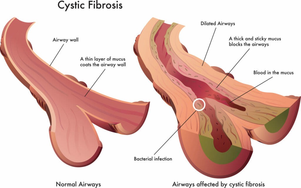 Cystic Fibrosis