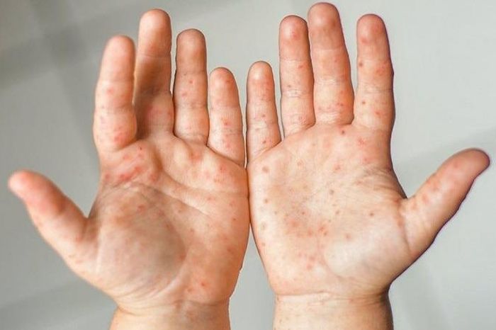 Hà Nội ghi nhận 5 ổ dịch tay chân miệng - Đài Phát thanh và truyền hình Hà Nội