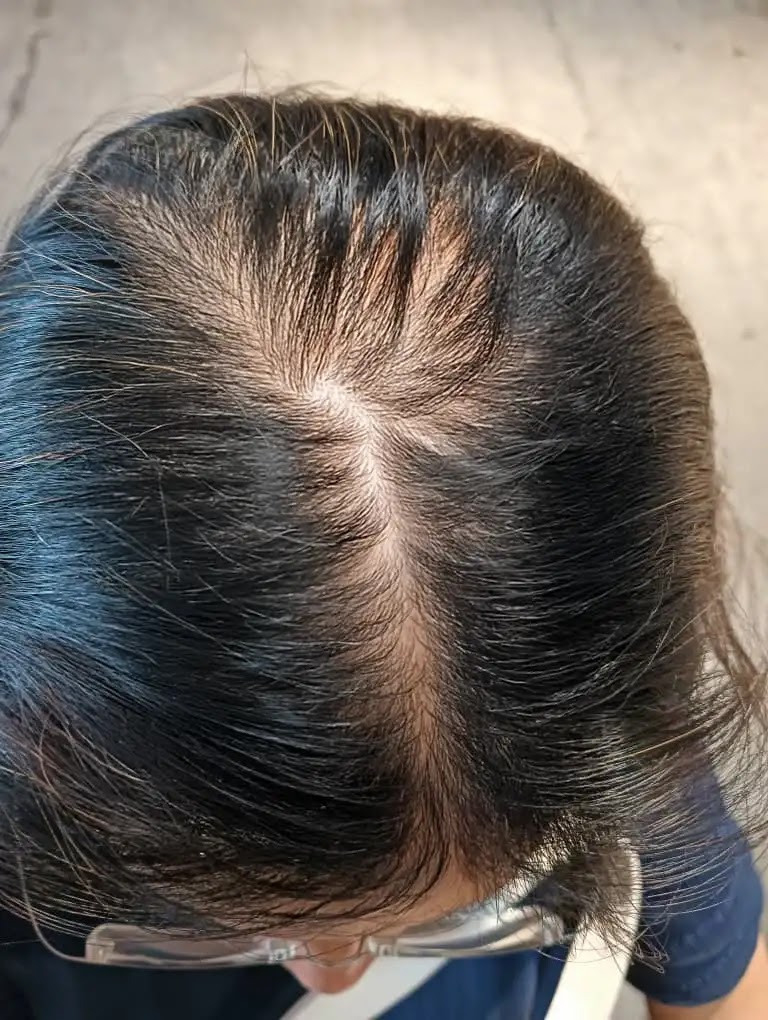 Female Pattern Baldness