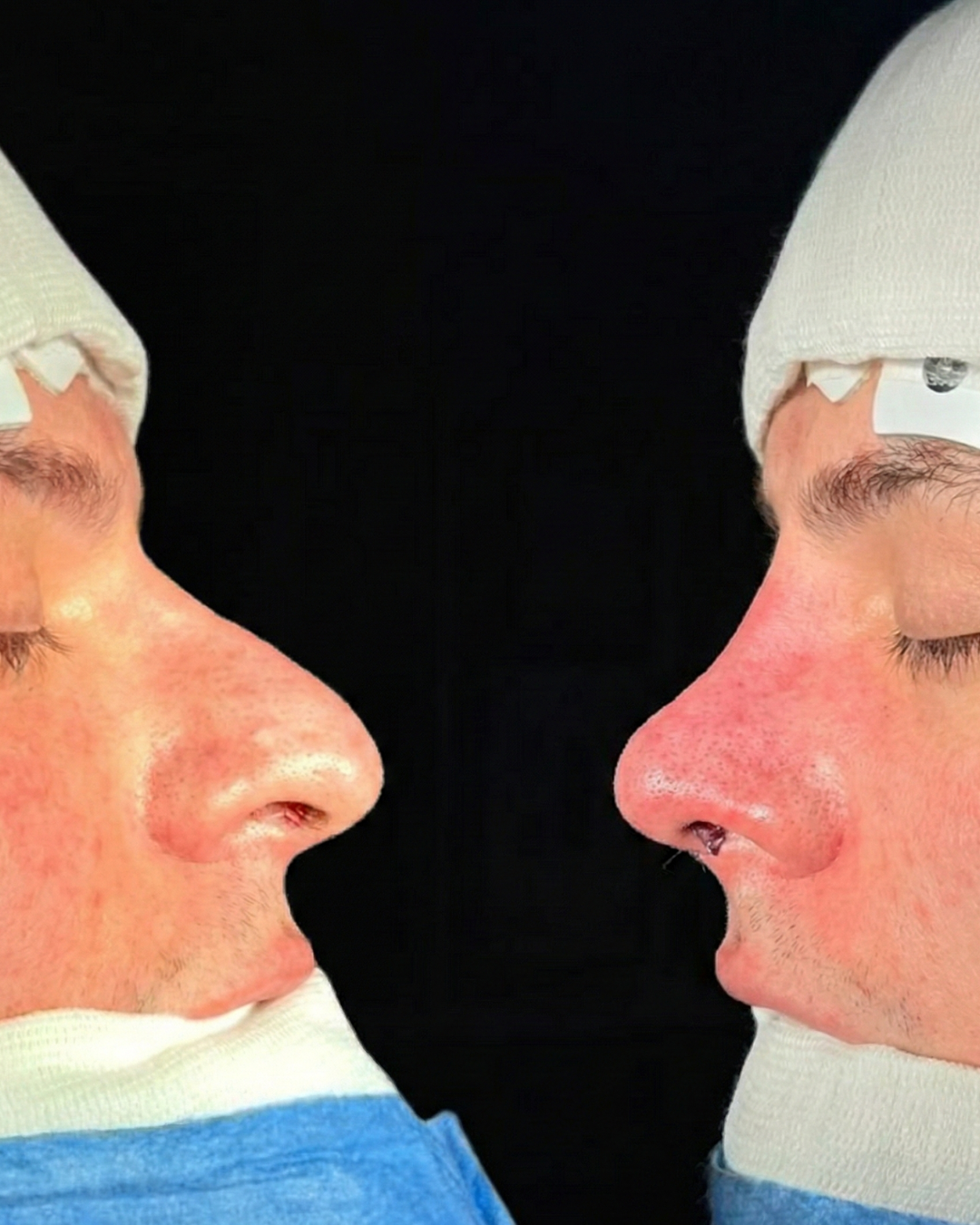 Rinoplastia Masculina