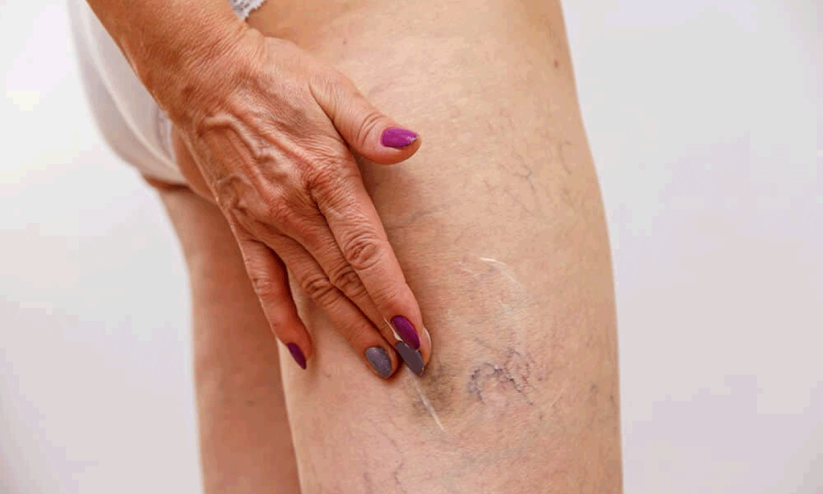 Instituciones internacionales se unen para formar especialistas en Flebología Vascular y Patología Venosa