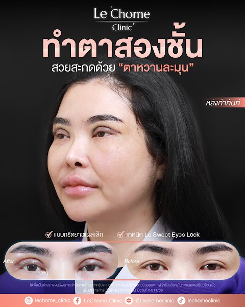 ตา 2 ชั้น