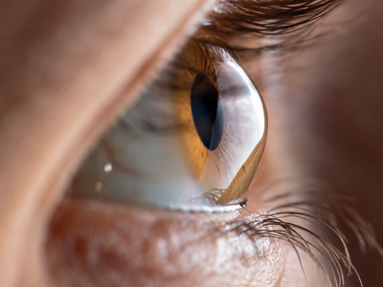 Corneal topography and cross-linking (CXL) at Dayal Eye Centre