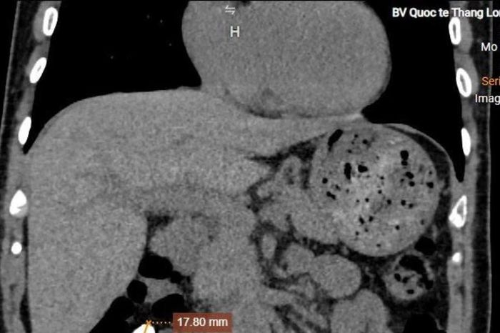 Uống nhầm thuốc sỏi thận nhiều năm, sự thật ngỡ ngàng khi chụp CT 'giải mã' - Báo Tri thức &amp; Cuộc sống