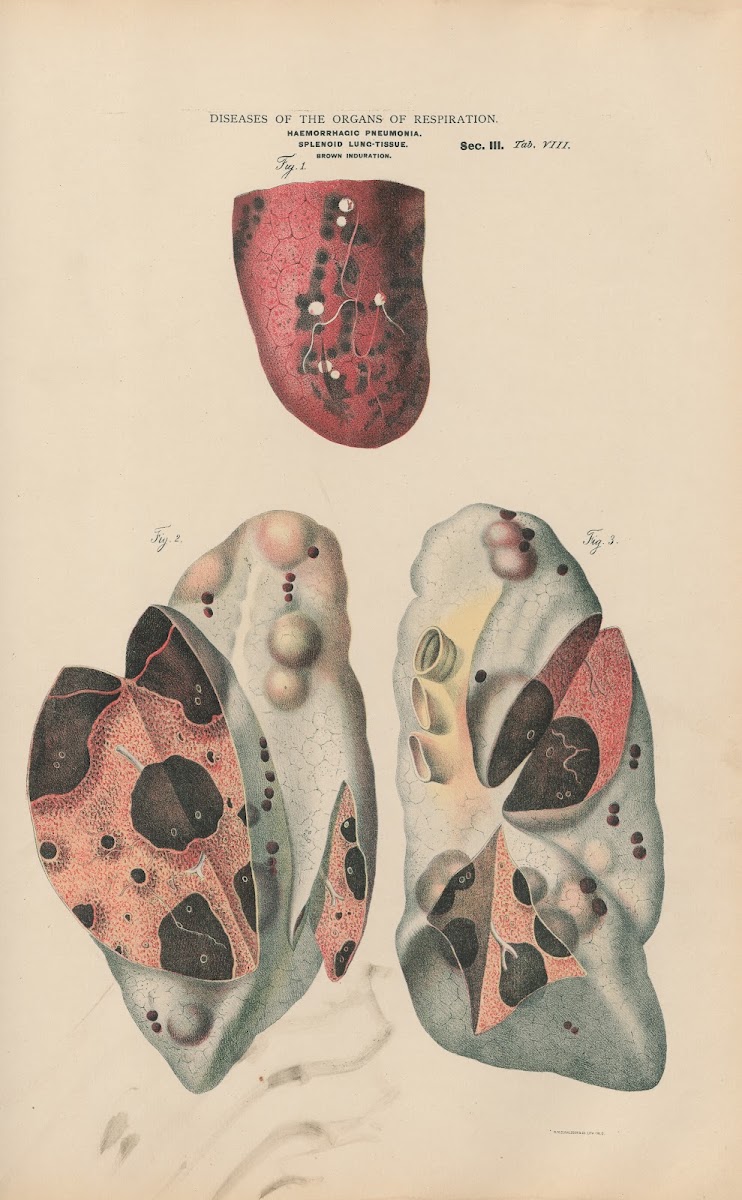 Embolic Pneumonia Infarct In Lung Tissue 1888