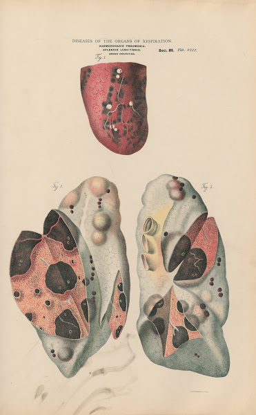 Embolic Pneumonia Infarct In Lung Tissue 1888