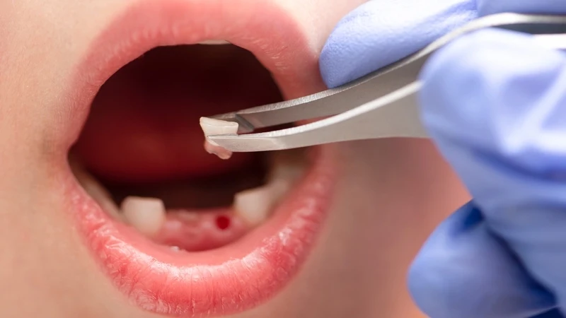 Bé 4 tuổi có nhổ răng được không là thắc mắc của nhiều bậc phụ huynh