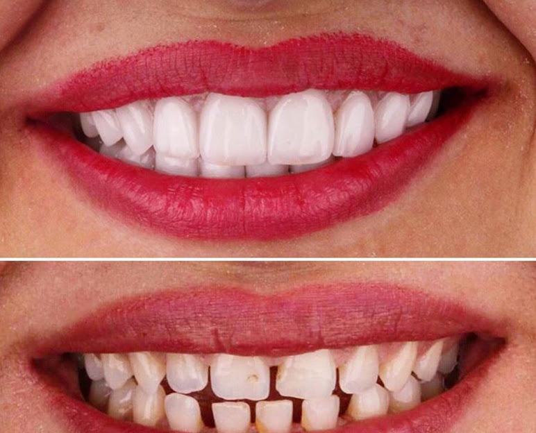 Patient Smile Transformation 1