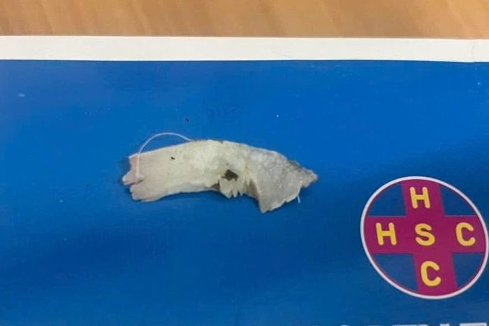 Người đàn ông 63 tuổi suýt gặp biến chứng nguy hiểm vì mảnh xương cá dài 4cm - Báo Tri thức &amp; Cuộc sống
