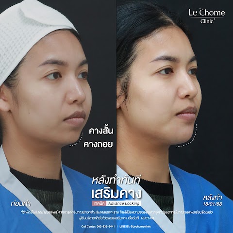 เสริมคาง (ใหม่)