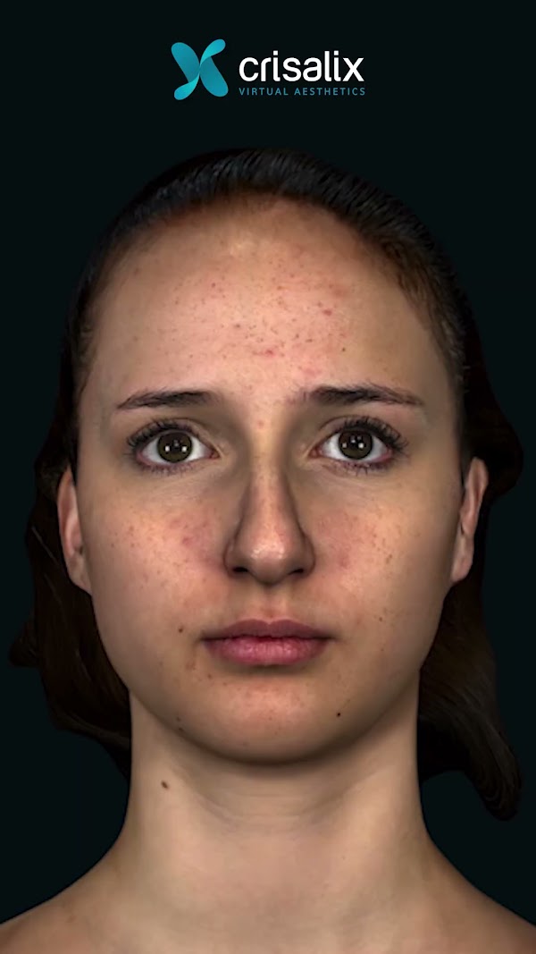 Face - Rhinoplasty