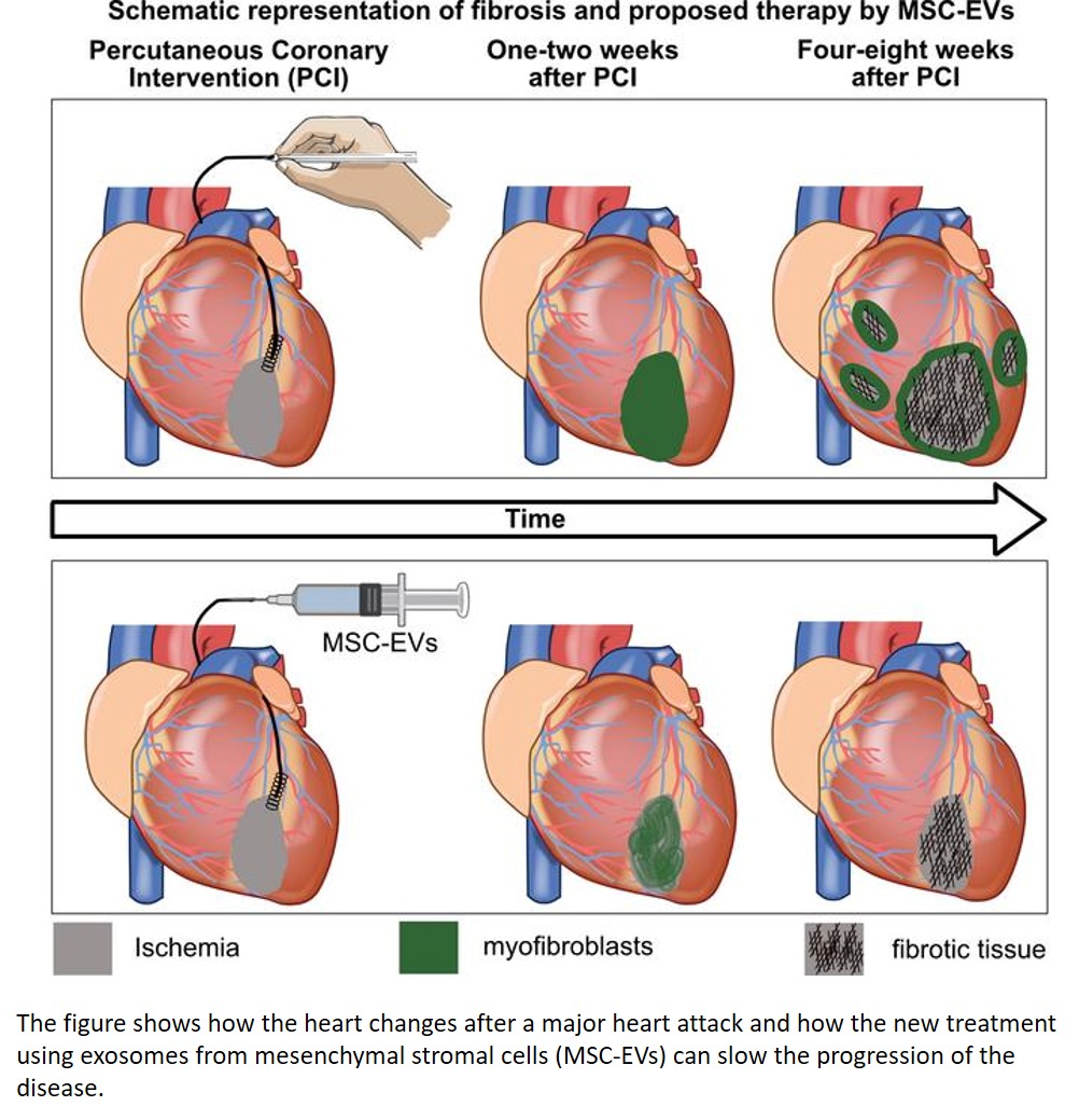 EV  scretome to treat cardiac fibrosis