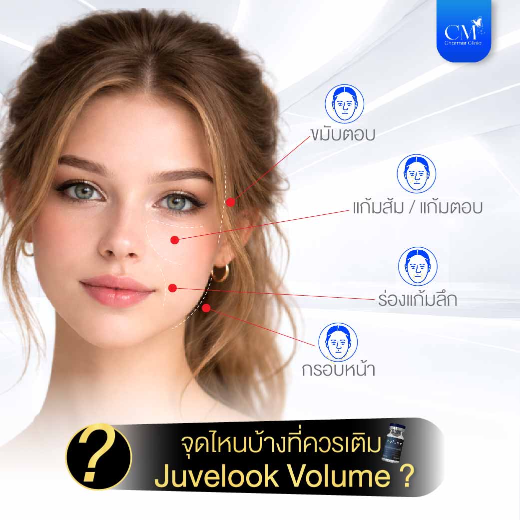 Juvelook Volume Face Mapping บริเวณที่ควรฉีด