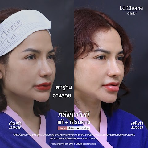 แก้ซิลิโคน+เสริมคาง