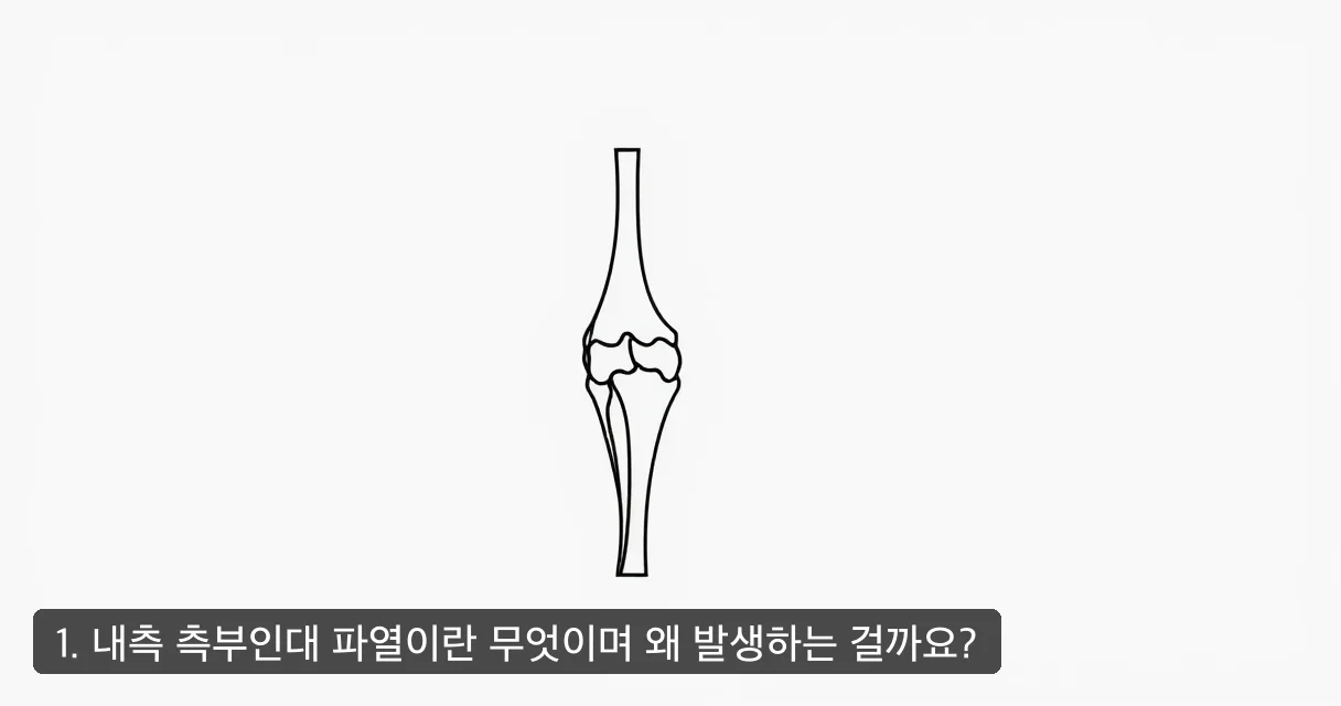 1. 내측 측부인대 파열이란 무엇이며 왜 발생하는 걸까요?