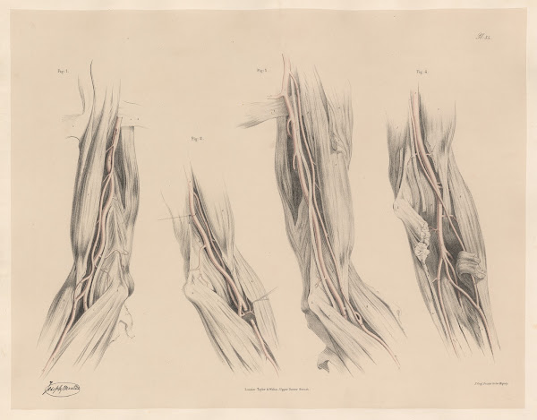 Various examples of Vasa Aberrantia extending from the Axillary 1844