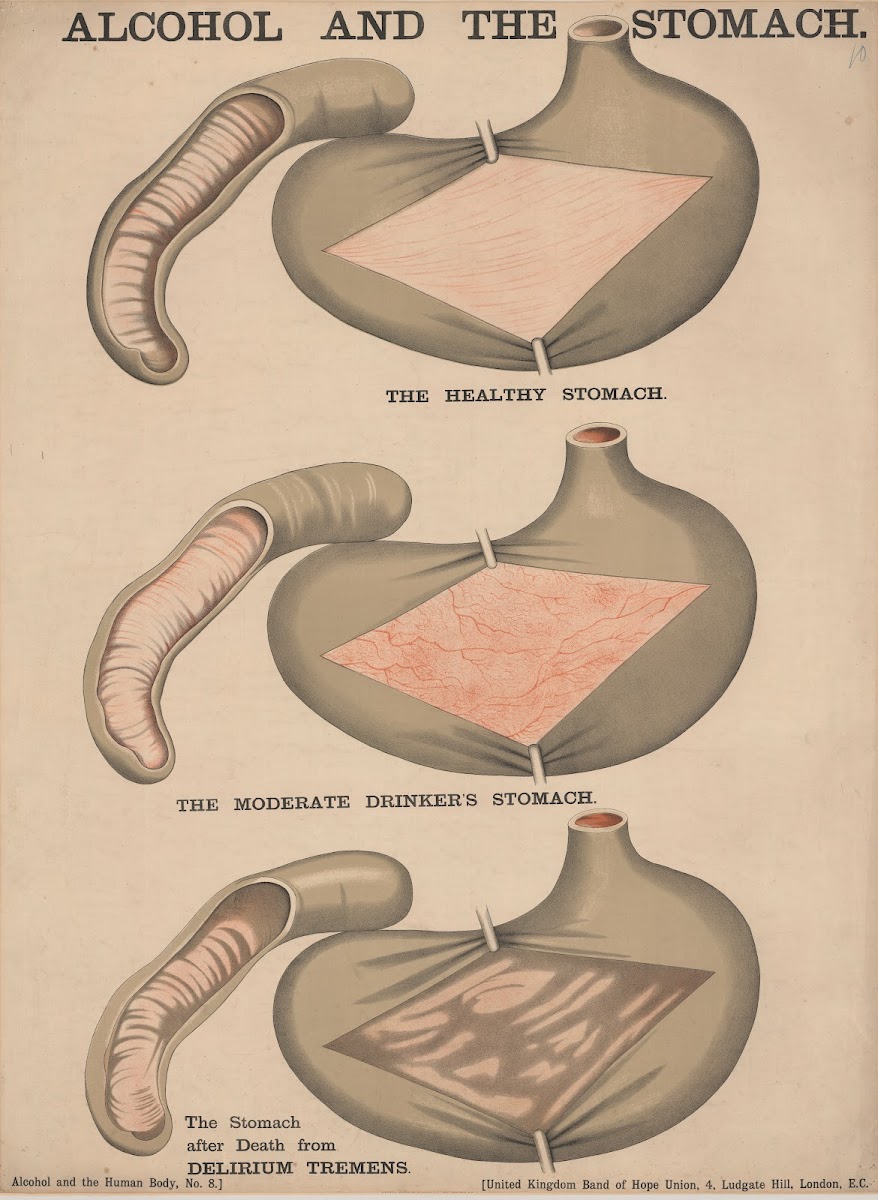 Alcohol and the Stomach 1890