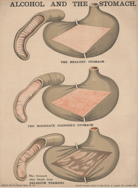 Alcohol and the Stomach 1890
