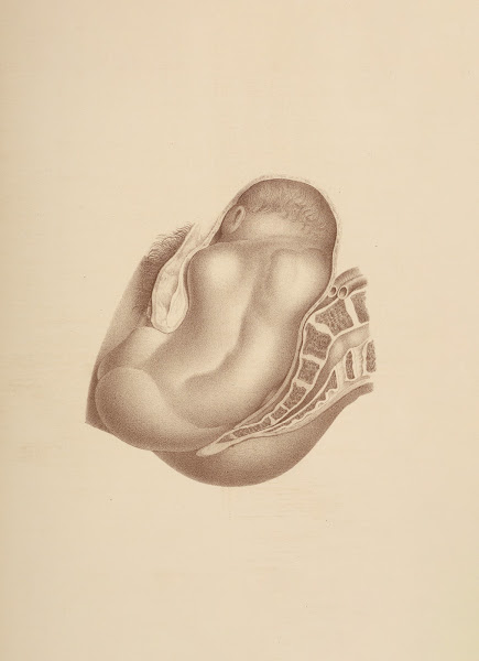 Mechanism of Natural Labor in the First Position of the Breech Left Sacro iliac