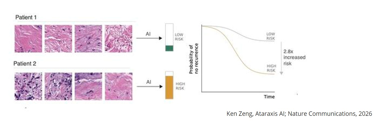 Multi-modal AI for comprehensive breast cancer prognostication