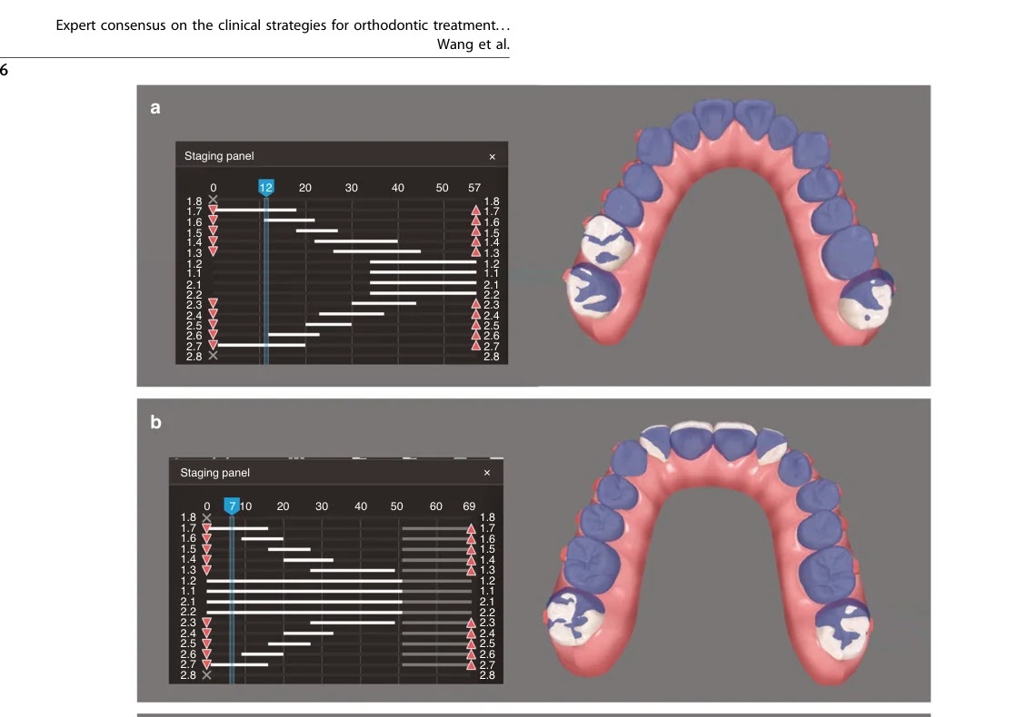 V-pattern 스테이징