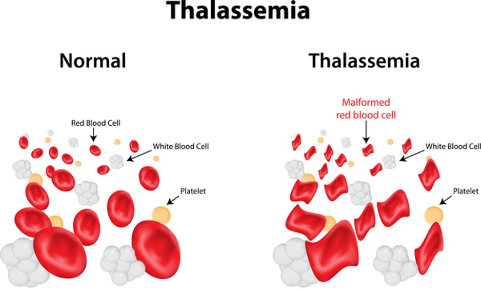 THALASSEMIA
