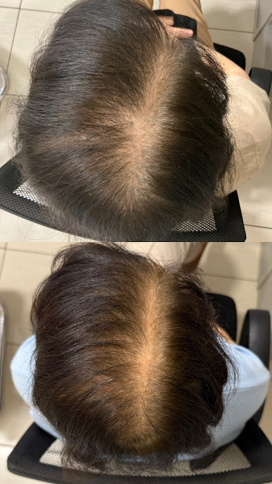 Antes e depois rarefação capilar feminina