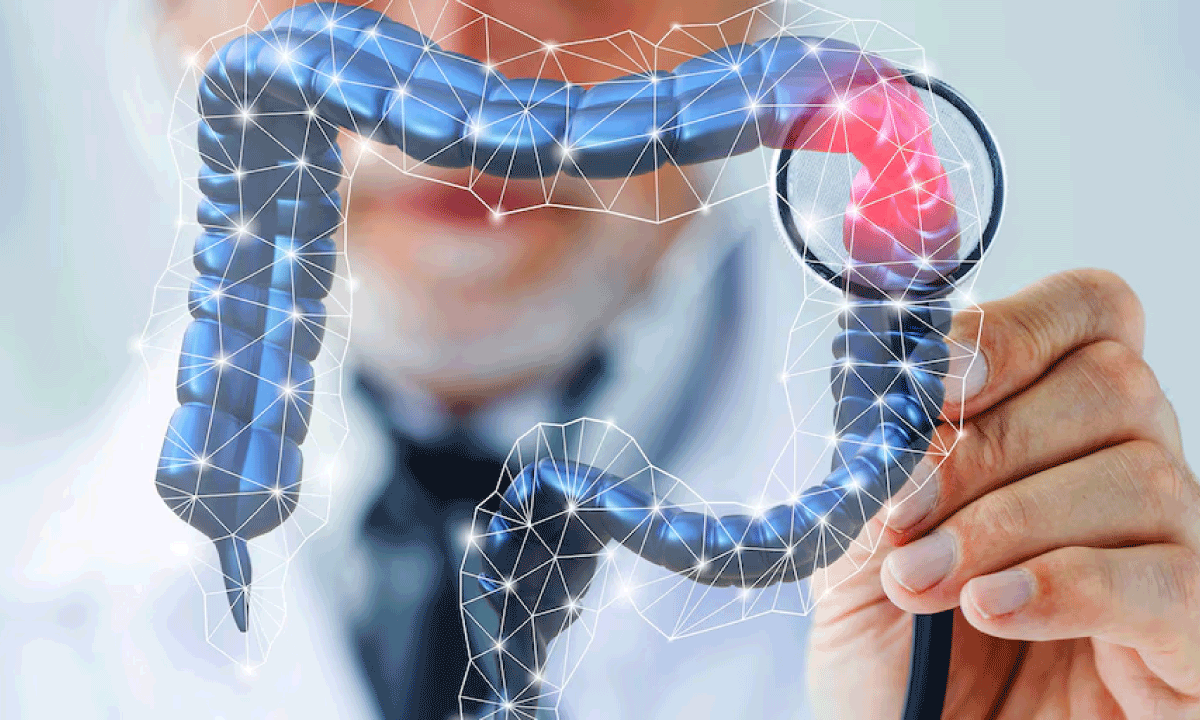 Preocupante aumento de cáncer colorrectal en menores de 50 años: Nuevos hallazgos reavivan debate sobre edad de detección